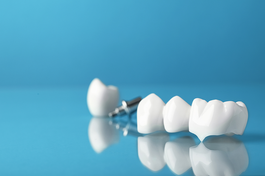 The Importance of Dental Crowns