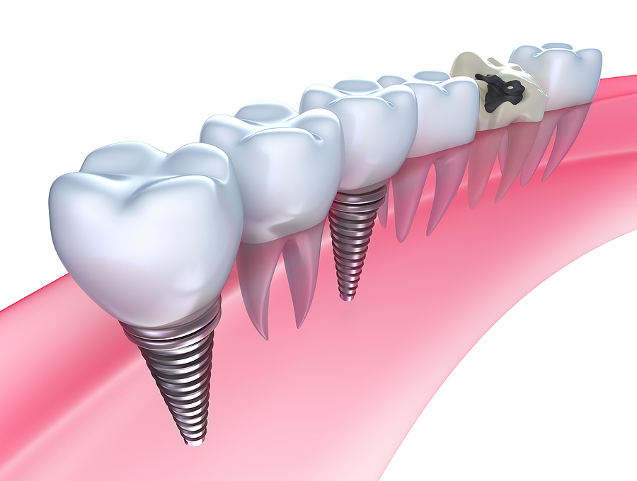 A Comprehensive Guide to Dental Implants in Fort Smith, AR
